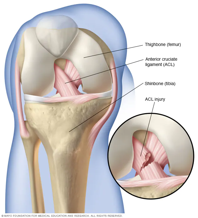 ALL YOU NEED TO KNOW ABOUT ACL (Anterior Cruciate Ligament) INJURY