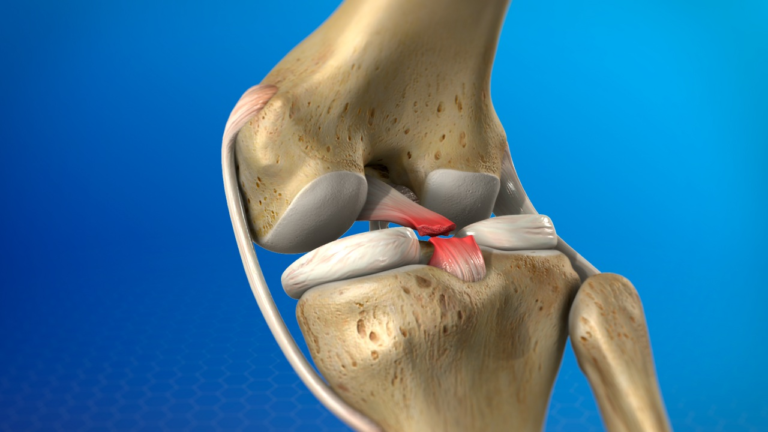 PCL (Posterior Cruciate Ligament) Injury: Causes, Symptoms, Diagnosis, and Treatment